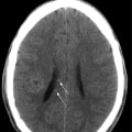 Understanding Diffuse Axonal Injuries: What You Need to Know