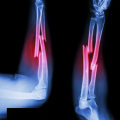 Understanding Arm Fractures: A Comprehensive Guide