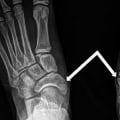 All You Need to Know About Leg Fractures