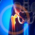 Understanding and Managing Bursitis: A Comprehensive Guide for Personal Injury Cases