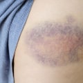 Understanding Contusions and Personal Injury Cases