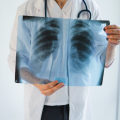 Rib Fractures: Understanding Your Legal Rights After a Personal Injury