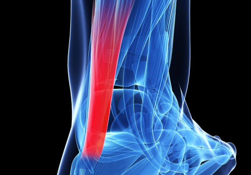 Understanding Tendonitis: Types, Causes, and Legal Options