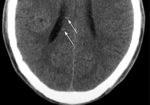 Understanding Diffuse Axonal Injuries: What You Need to Know