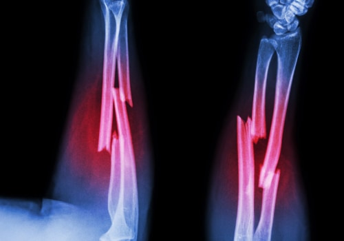 Understanding Arm Fractures: A Comprehensive Guide