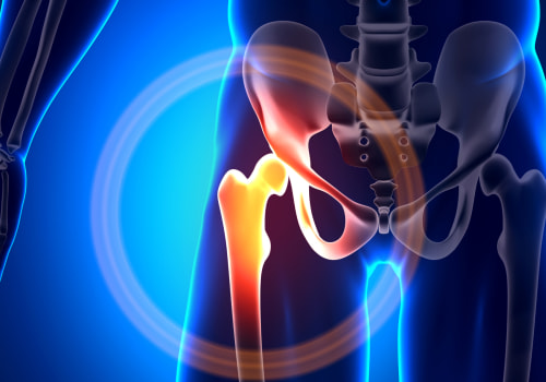 Understanding and Managing Bursitis: A Comprehensive Guide for Personal Injury Cases