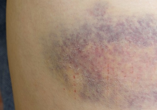 Understanding Contusions and Personal Injury Cases