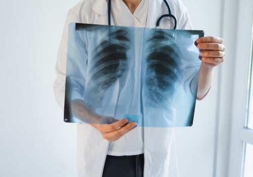Rib Fractures: Understanding Your Legal Rights After a Personal Injury